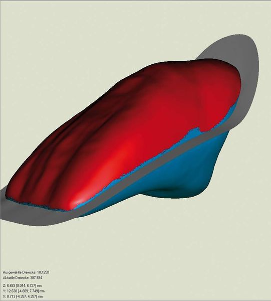 Bild 1: 3D-Modell eines Zahnes. Die rote Färbung zeigt die Ideallinie, um einen Hinterschnitt zu vermeiden. (Archiv: Vogel Business Media)