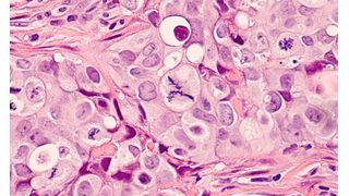 Abb. 1: Neu entwickelte lichtaktivierbare Nanopartikel zeigten in biologischen Untersuchungen eine starke Aktivität gegen verschiedene Tumorzelllinien. (Symbolbild) (Bild: © David A Litman - stock.adobe.com)