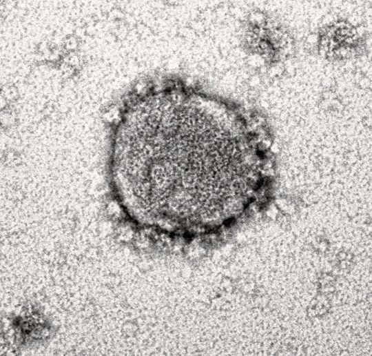 Das neue Coronavirus steht im Zentrum zahlreicher Forschungsprojekte des Ulmer Instituts für Molekulare Virologie. Jetzt haben die Forschenden einen vielversprechenden zelleigenen und antiviralen Faktor charakterisiert Das neue Coronavirus steht im Zentrum zahlreicher Forschungsprojekte des Ulmer Instituts für Molekulare Virologie. Jetzt haben die Forschenden einen vielversprechenden zelleigenen und antiviralen Faktor charakterisiert