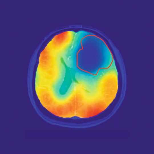 Die rote Linie markiert das Tumorareal; der farbige Kontrast zeigt den Sauerstoff-Stoffwechsel an. Wie vom Warburg-Theorem vorhergesagt, ist der Sauerstoff-Umsatz im Tumor reduziert (blau). Die rote Linie markiert das Tumorareal; der farbige Kontrast zeigt den Sauerstoff-Stoffwechsel an. Wie vom Warburg-Theorem vorhergesagt, ist der Sauerstoff-Umsatz im Tumor reduziert (blau).