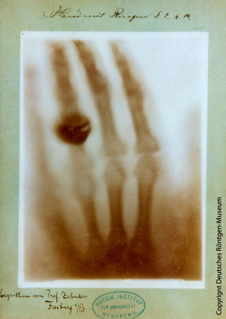 Die erste veröffentlichte und zeitlich genau dokumentierte Röntgenaufnahme war die Hand von Wilhelm Conrad Röntgens Frau Bertha. Die Aufnahme stammt vom 22. Dezember 1895.
