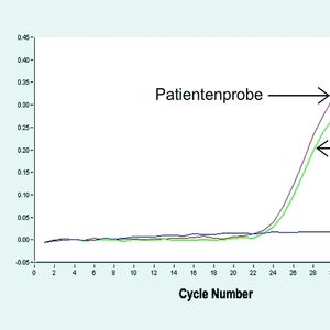 Abb. 2a	 Die genomische DNA wurde aus 150 µl humanem EDTA-stabilisiertem Vollblut mit Hilfe des Invimag Blood DNA Mini Kit/KFmL auf dem Kingfisher mL isoliert. Zwei Mikroliter der eluierten DNA (1/50) wurden in der qualitativen PCR im Lightcycler eingesetzt. (Rote Kurve: Patientenprobe, Grüne Kurve: Heterozygote Kontrollprobe).
