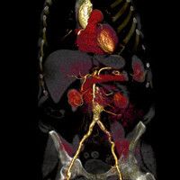 CT Angiografie einer Patientin mit schlechter Nierenfunktion. Die Untersuchungszeit betrug nur 1 Sekunde. Die Kontrastmittelmenge konnte von 150 ml auf nur 40 ml reduziert werden. (Bild: Universitätsmedizin Mannheim)