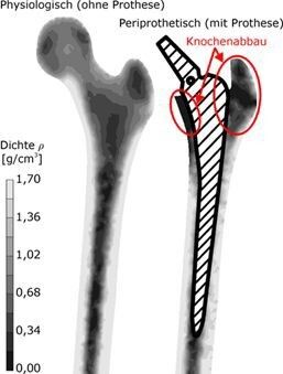 Gegenüberstellung der berechneten Dichteverteilung im Femur in der Frontalschnittebene für den präoperativen Zustand ohne Prothese (li.) und postoperativ nach Einbau der Prothese (re.). (Bild: IFUM)