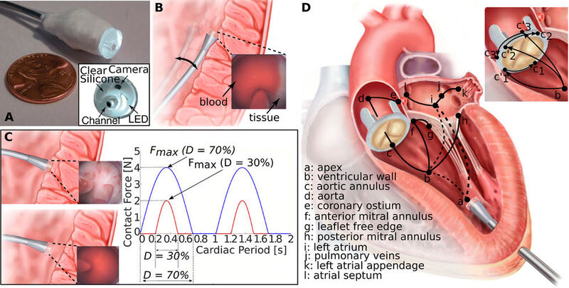 Einen mit Sensoren und Software ausgestatteten Katheter haben Wissenschafter entwickelt, der autonom in der Vene zum Herzen navigiert.