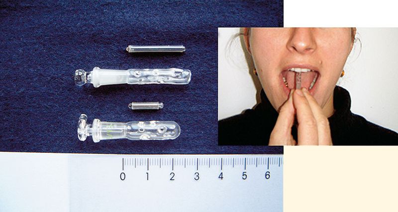 Abb.3: Um den Kontakt und somit eine direkte Extraktion von Substanzen aus der Mundschleimhaut zu verhindern, wurde ein System entwickelt, mit dem sich der Twister verkapseln lässt: BOSS gewährleistet einen ungehinderten Zutritt von Speichel und Gasphase und damit eine Extraktion von Aromastoffen. (Archiv: Vogel Business Media)