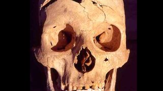 Wissenschaftler erhoben Daten von 15.000 menschlichen Skeletten aus mehr als 100 Regionen Europas: hier ein Schädel mit deutlich erkennbarer Hiebverletzung. (Joachim Wahl, Landesdenkmal Amt im Regierungspräsidium Tübingen)