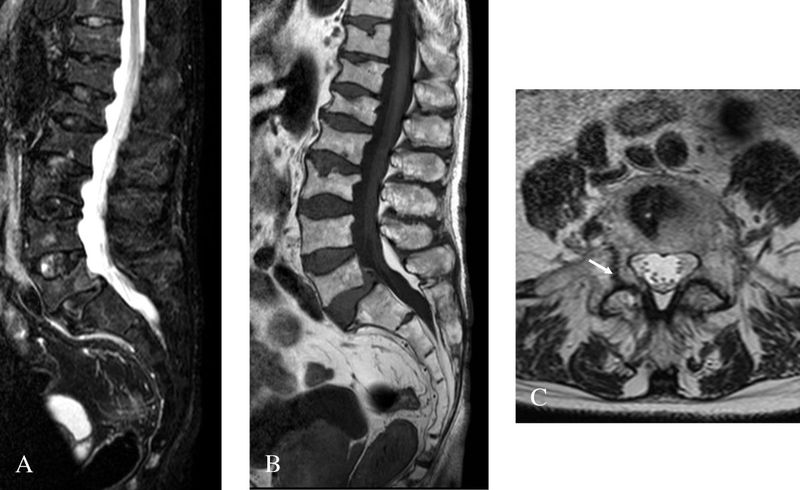 Weitere 2,1 Millionen Patienten, werden in den kommenden 33 Jahren in Deutschland an Osteoporose, im Volksmund auch Knochenschwund genannt, erkranken.  Weitere interessante Beiträge rund um das Thema Gesundheit:    - Was steuert unsere Lebenserwartung?      - Was sagt die Genetik über Ursachen der Schlaflosigkeit?      - Leere Bäuche lernen gerne?   (Bild: Dr. Robert Carlier - Eigenes Werk, CC BY 2.0, https://de.wikipedia.org/wiki/Morbus_Fabry#/media/File:Morbus_Fabry_MRT_Osteoporosis_01.jpg) (Bild: Dr. Robert Carlier)