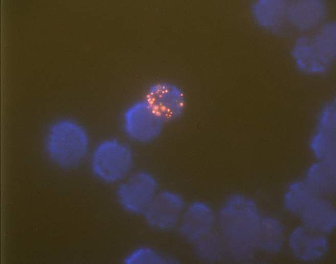 Fluoreszens in situ Hybridisierung (FISH) zur Bestimmung der Genamplifizierung von HER 2 = erb/B2. (Archiv: Vogel Business Media)