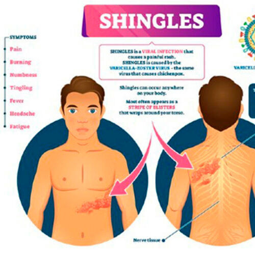 About one in three people get shingles, which causes a painful rash. 
