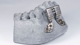 Solche kieferorthopädischen Distraktoren werden heute als Standardteil gefertigt und erst im Operationsprozess angepasst: Langwierig und unangenehm für den Patienten. In Zukunft könnten sie per 3D-Druck für den jeweiligen Patienten individuell angefertigt werden. (Christoph Wilsnack/Fraunhofer IWS)
