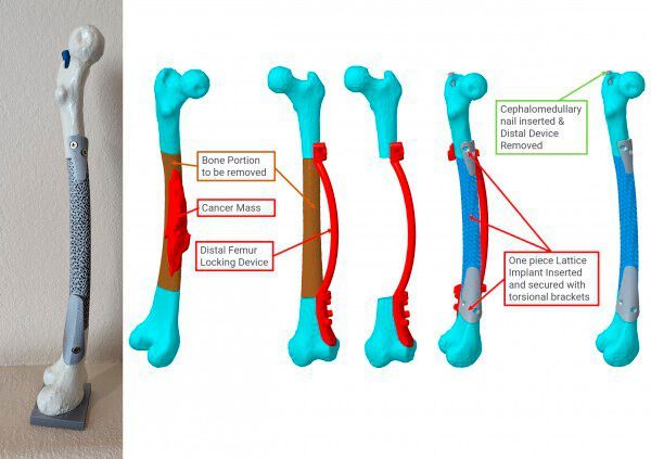 Ein Oberschenkelimplantat mit Gitterstrukturen für Knochenkrebspatienten um eine Amputation zu verhindern hat Advanced Engineering Solutions entwickelt. (Bild: 3DPC)