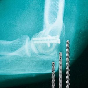 Ein Osteosynthese-System besteht aus einer der Anatomie angepassten Platte, die mit einer unterschiedlichen Anzahl von Schrauben in unterschiedlichen Längen und Durchmessern in die Knochen geschraubt werden.