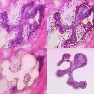 2 Lasermikrodissektion von Epithelzellen aus Brustgewebe (FFPE, H&E; Bild: Carl Zeiss MicroImaging GmbH)