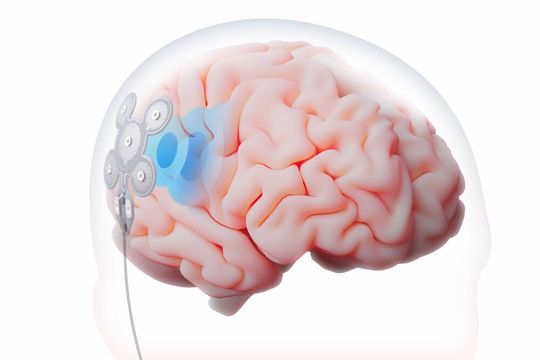 The brain remains untouched: The electrode mat (Laplace electrode) placed under the skin stimulates the cortex with electrical pulses through the skull.(Image: Precisis)