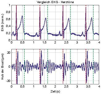 Bild 3:  Eine Darstellung von Herztönen, die mit einem Radar gemessen wurden im Vergleich zu einer zeitsynchronen EKG-Referenz.
