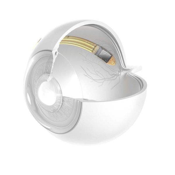 Das subretinales Netzhautimplantat Alpha AMS von Retina Implant kann helfen, zumindest ein gewisses Sehvermögen wiederherzustellen. (Retina Implant)