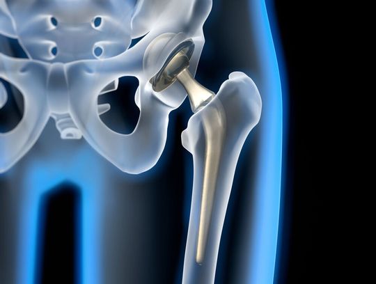 Seit Ende 2012 sammelt und analysiert das Endoprothesenregister Daten zu Hüft- und Knieendoprothesen in Deutschland, um mehr über die Ursachen von Folgeeingriffen und die Lebensdauer von Implantaten im menschlichen Körper zu erfahren. (Bild:  peterschreiber.media - stock.adobe.com)