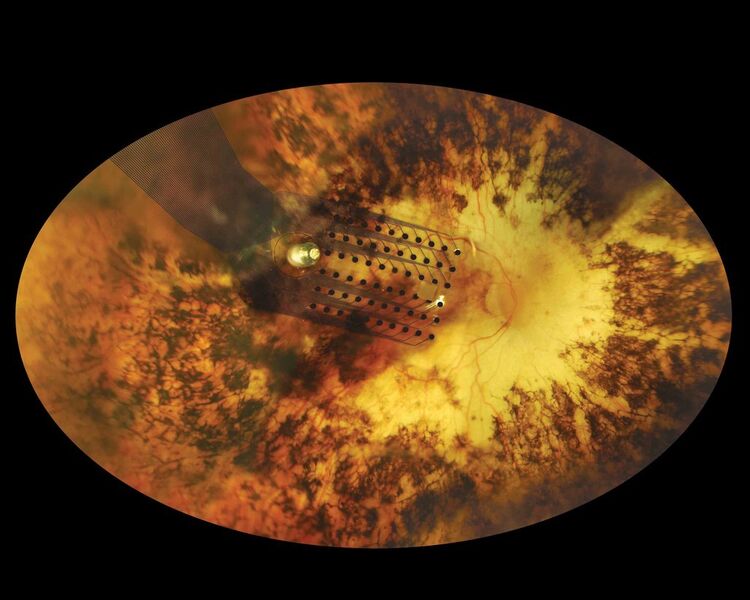 Blick in das Auge: Deutlich zu erkennen ist das Implantant, über das Patienten wieder vereinfacht sehen können. (Secondsight)