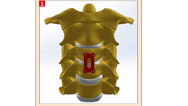 Fig. 1 Schematic representation of cervical spine with fusion plate made by (HDPE) composite.(Bild:)
