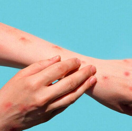 Researchers show how the wastewater epidemiology method could be optimized for monkeypox, potentially detecting as few as seven infections per 100,000 people. Researchers show how the wastewater epidemiology method could be optimized for monkeypox, potentially detecting as few as seven infections per 100,000 people.