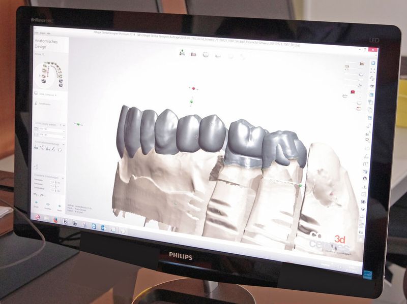 Davon profitieren Patient und Zahnarzt: Der digitale Workflow im Dentallabor senkt deutlich die Kosten und kürzt die Durchlaufzeiten vom Intraoralscan bis zum fertigen Zahnersatz auf wenige Tage. (Rego-Fix)