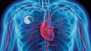 Elektronische Implantate: Mit der Energie aus den menschlichen Zellen sollen sich künftig auch Herzschrittmacher energieautark betreiben lassen. (©peterschreiber.media - stock.adobe.com)