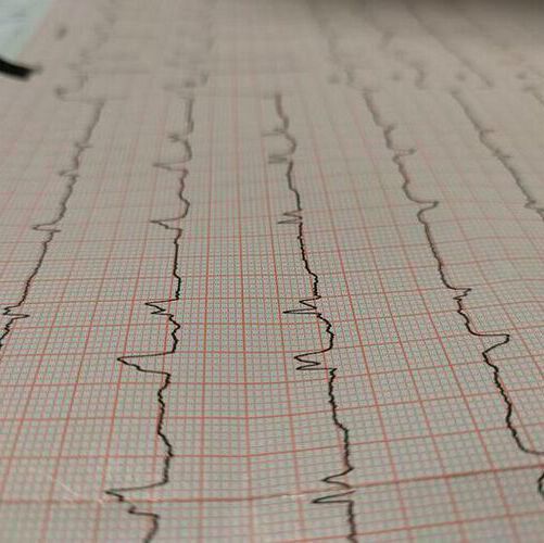 First Patient Enrolled for Trial that Prevents Sudden Death After Heart ...