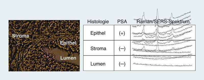 Abb. 4 Proof of principle der Immun-SERS-Mikroskopie: Lokalisierung des Prostata-spezifischen Antigens (PSA) in einem Prostata-Gewebeschnitt. Im Weißlichtmikroskopbild (links) sind die histologischen Klassen markiert. Die Korrelation zwischen Histologie, PSA-Vorkommen und Raman/SERS-Signatur ist rechts daneben gezeigt. (Archiv: Vogel Business Media)