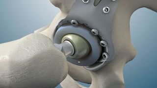 Die Implantation einer Hüft-Endoprothese ist eine enorme Belastung für den Patienten. Hier im Modell zu sehen: ein modulare Revisions-Stützpfanne für den Hüftgelenkersatz. (Bild: Peter Brehm GmbH)