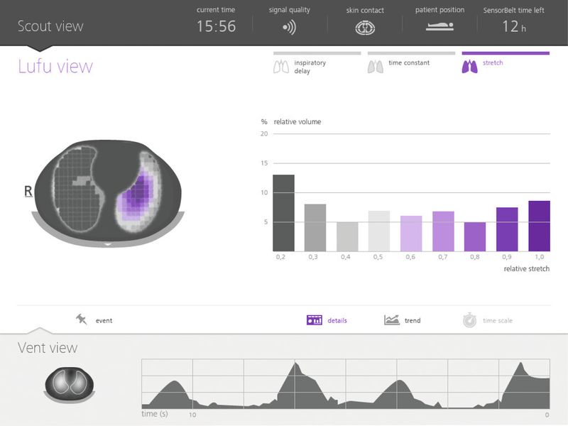 Die Lufu-View visualisiert, wie häufig einzelne Parameterausprägungen in verschiedenen Lungenregionen vorkommen. (Bild: Swisstom /User Interface Design)
