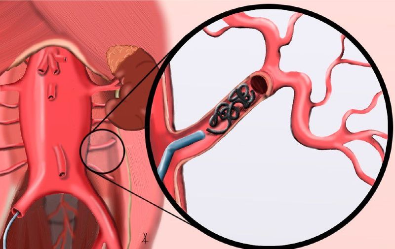In dieser Form werden ausgewählte Segmentarterien mithilfe so genannter Coils verschlossen. (Konstantin von Aspern/Universität Leipzig)