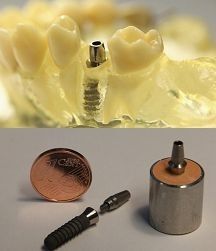Dentale Implantat-Abutments. (Bild: SFB599)