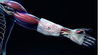 Eine koordinierte Stimulation der Mikroimplantate unterstützt bei der Ausführung von Handbewegungen. (Bild: Wilddesign GmbH, Gelsenkirchen)
