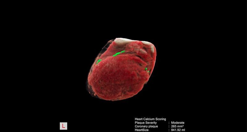 Aus Thorax CT-Aufnahmen erkanntes und segmentiertes Herz mit Herzkranzgefäßen, grün durch KI markiert sind Messungen der Verkalkungen der Herzkranzgefäße. (Siemens Healthineers)