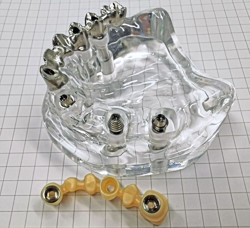 Transparentes Kiefermodell mit Implantaten, Abutment und gefrästem Zahnersatz aus Metall (oben) bzw. Zirkon-Keramik (unten).