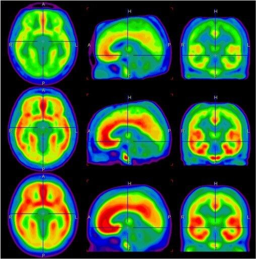 Die Tomographie-Bilder zeigen, dass die Bindung zum mGluR5-Protein (rot=starke Bindung) im Gehirn von Rauchern im Durchschnitt um bis zu 30 Prozent verringert ist (oberste Reihe). Auch die Ex-Raucher (mittlere Reihe) zeigten eine Reduktion dieses Proteins um bis zu 20 Prozent. Die unterste Reihe zeigt die Menge des Proteins im Gehirn von Menschen, die nie geraucht haben. (Bild: UPD, Universität Bern / PET-Zentrum, Universitätsspital Zürich)
