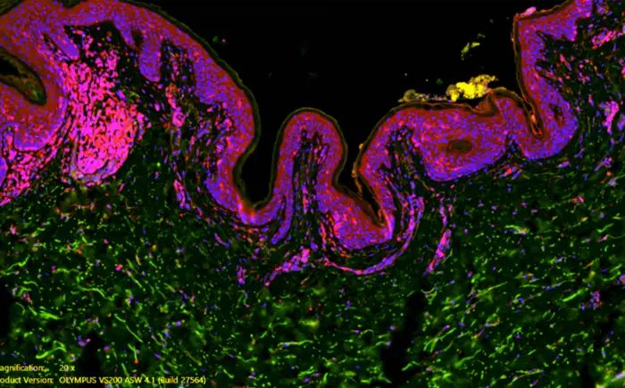  Hormon-verändernde Chemikalien  Hidradenitis suppurativa (HS) ist eine entzündliche Hautkrankheit mit schmerzhaften Knoten und Abszessen, oft in Hautfalten. Eine kleine Studie der Johns Hopkins Medicine (12 Betroffene, 8 Kontrollen) deutet darauf hin, dass hormonstörende Chemikalien aus stark verarbeiteten Lebensmitteln und Einwegplastik (z. B. Bisphenole, Phthalate) HS mitauslösen oder verschlimmern können.  In Hautproben von HS-Patienten fanden Forschende weniger des Proteins/Gens Nicastrin (NCSTN) in bestimmten Hautzellen (Fibroblasten). Wenn NCSTN fehlt, reagieren diese Zellen stärker auf Entzündungssignale und produzieren mehr Entzündungsstoffe. Außerdem zeigten sich in HS-Haut mehr Abbauprodukte der genannten Plastik-Chemikalien. Im Labor senkte ein Mix dieser Stoffe NCSTN dosisabhängig und erzeugte ein ähnliches Entzündungsmuster.  Die Ergebnisse sprechen dafür, dass weniger Kontakt mit solchen Chemikalien bei einigen Menschen die HS-Beschwerden mindern könnte. Es sind jedoch größere Studien nötig, um diesen Effekt zu bestätigen.  Hier gehts zur OriginalmeldungWissenschaftsbild des Tages vom 11.12.2025  (Bild: Kaitlin Williams, Johns Hopkins Medicine)