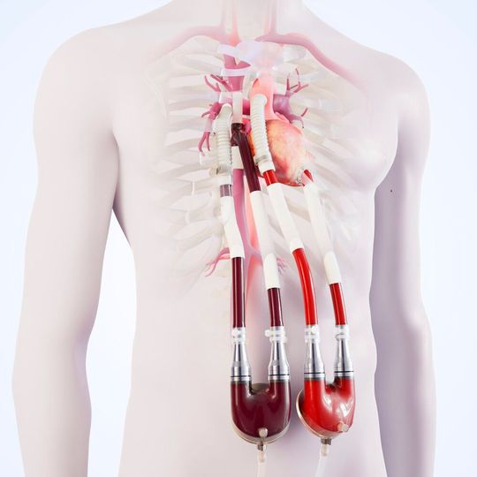 Die Venenkanüle bietet Patienten mit einem versagenden Fontan-Kreislauf die Chance, die Wartezeit auf ein Spenderherz zu überbrücken.(Bild:  Berlin Heart)