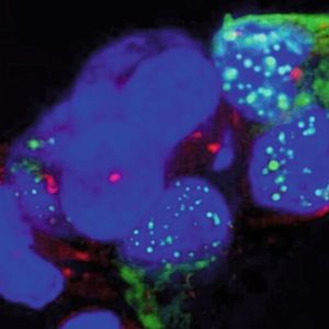 Die grünen Punkte sind Proteinaggregate in den Zellkernen. In Zellen, die einfarbig blau erscheinen, haben sich (noch) keine Aggregate gebildet.(Bild:  Thorsten Müller)