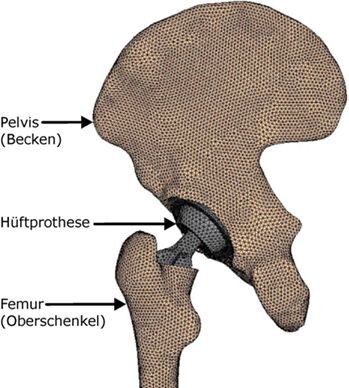 FE-Modell des Knochen-Prothese-Verbundes. (Bild: IFUM)
