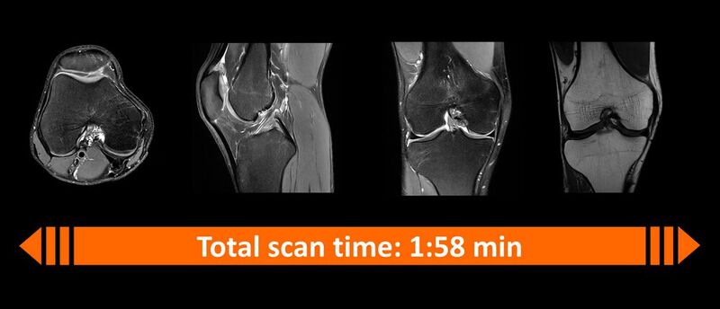 Die Kombination aus Deep Resolve und der Simultaneous-Multi-Slice-Technologie ermöglicht es, das gesamte Knie in zwei Minuten zu scannen.