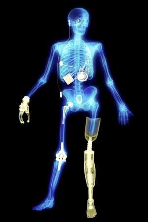 Le corps humain est susceptible d’accueillir de nombreux implants. (Image Département de chimie/Université de Fribourg) (Archiv: Vogel Business Media)