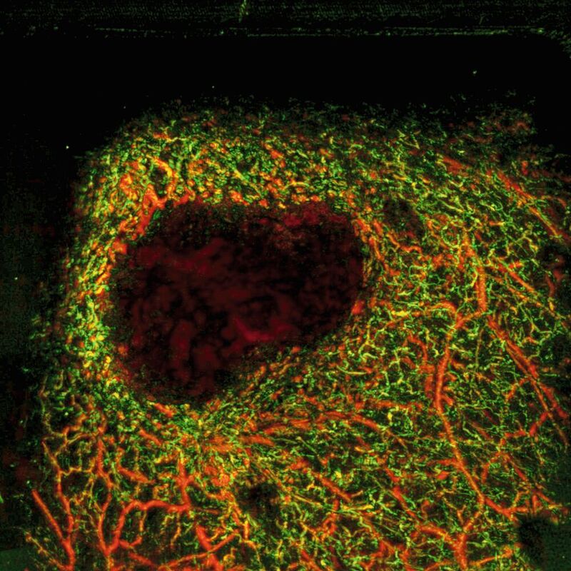 Eine mit dem RSOM-System erstellte optoakustische Aufnahme eines Melanoms (dunkler Bereich) in Hautgewebe mit der ihn umgebenden Struktur feinster Blutgefäße.