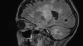 Entzündungsherde (helle Zonen) im Gehirn von Multiple-Sklerose-Patienten, die an einer progressiven multifokalen Leukoenzephalopathie (PML) erkrankt sind. (Bild: Neuroradiologie, USZ)