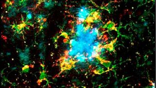 Amyloide Proteinablagerungen (Plaques, blau) in der Großhirnrinde eines Mausmodells der Alzheimer-Erkrankung, umhüllt von kortikalen Immunzellen (Mikroglia, grün). In rot sind diejenigen Mikrogliazellen markiert, die die Fresseigenschaften hoch reguliert haben (positiv für CD-68).  (O. Garaschuk/PNAS)