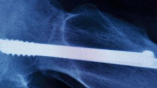 Abb. 1: Sie stabilisieren beispielsweise verletzte Knochen und ermöglichen so deren Heilung: Medizinische Implantate (©edwardolive - stock.adobe.com)