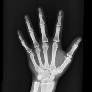 Die Röntgenstrahlen wurden 1895 von Wilhelm Conrad Röntgen in Würzburg entdeckt – allerdings rein zufällig. Der Physiker forschte zu der Zeit gerade an Kathodenstrahlen, als ihm ein leuchtendes  Stück Papier in seinem Labor auffiel: Das Papier war mit einem Material beschichtet, das unter ultraviolettem Licht und unter Kathodenstrahlung leuchtete. Die „X-Strahlen“, wie er seine Entdeckung nannte, konnten weiche Materie durchdringen und führte bald zu einem Durchbruch in der medizinischen Diagnostik. (Bild:   / CC0)