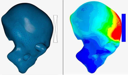 Auch patientenspezifische Anatomien aus CT-, US- oder MRT-Verfahren können in der Simulation relativ einfach abgebildet werden und gerade bei der Analyse von sporadischen Reklamationen sehr aufschlussreich sein. Im Bereich der Orthetik/Prothetik gibt es heute schon besonders viele Anwendungsfelder. Hier im Beispiel wird der stumpfe Aufprall eines Schädels mit und ohne Schutzausrüstung verglichen. (Bild:  bolts&bytes engineering)