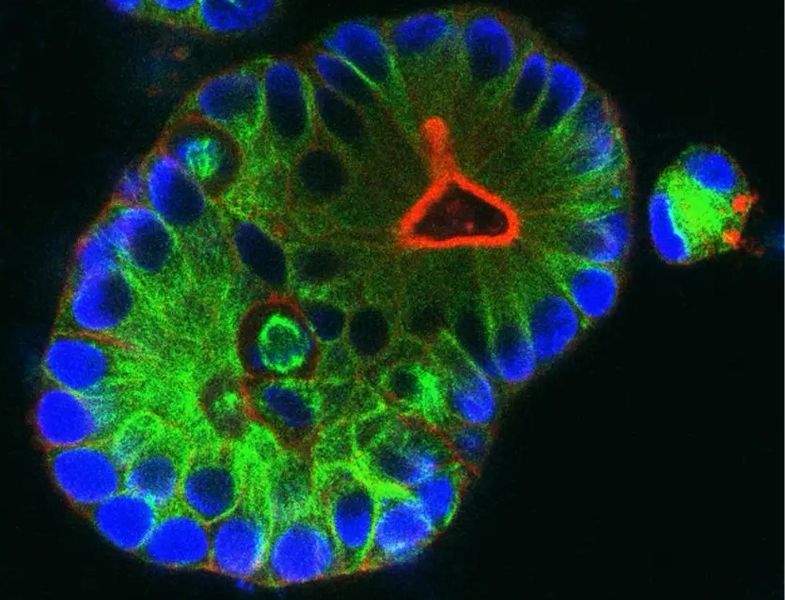 Mini-Darmkrebs Modelle   Darmkrebs ist eine der Hauptursachen für krebsbedingte Sterblichkeit, wobei mehr als ein Drittel der Darmkrebsfälle ihren Ursprung im Enddarm haben. Bösartige Veränderungen des Enddarms, so genannte Rektumkarzinome, werden dabei häufig erst in einem fortgeschrittenen Stadium diagnostiziert, wenn der Tumor schon eine gewisse Größe erreicht hat.  Um die chirurgische Entfernung des Tumors zu erleichtern, werden diese Patienten in der Regel vor der Operation mit einer Kombination aus Chemo- und Strahlentherapie behandelt. Allerdings gehen viele Chemotherapien mit einer Reihe von Nebenwirkungen einher und es fehlt bislang an gezielten medikamentösen Therapieansätzen, die molekulare Schwachstellen des Tumors ausnutzen, um ihn wirksam zu bekämpfen.  Ein Forschungsteam unter der Leitung von Professoren Johannes Betge und Tianzuo Zhan untersucht alternative Strategien mit vielversprechenden Ergebnissen. Sie verwenden Organoide zur Simulation von Tumoren und testen Medikamentenkombinationen zur Verstärkung der Strahlentherapie. Besonders MEK-Inhibitoren und PARP-Inhibitoren erwiesen sich als effektiv zur Tumorkontrolle, indem sie gezielt in die Zellprozesse von Krebszellen eingreifen. MEK-Inhibitoren machen die Zellen empfindlicher für Strahlung. PARP-Inhibitoren stören die Fähigkeit der Zellen, DNA-Schäden zu reparieren.  Das Bild zeigt Mini-Tumore, sogenannte Organoide, welche aus dem Gewebe von Enddarmkrebs hergestellt wurden. Sie dienen als Modell des Tumors, um neue Therapien zu testen.  Hier gehts zur Originalmeldung Wissenschaftsbild des Tages vom 14.8.2025  (Bild: Johannes Betge)
